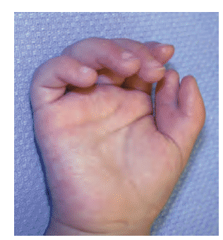 Early Treatment Can Support Better Hand Function in Children